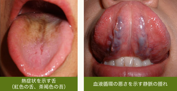熱症状を示す舌と血液循環の悪さを示す静脈の腫れ