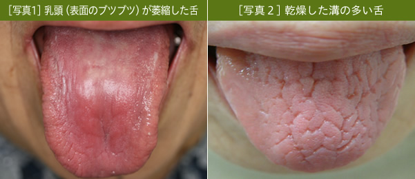 [写真1] 乳頭（表面のブツブツ）が萎縮した舌　[写真２] 乾燥した溝の多い舌