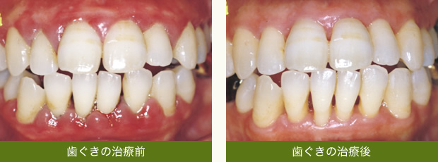 歯ぐきの治療前　歯ぐきの治療後