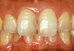 歯と歯の間の色の変化
