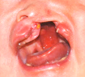 口唇裂・口蓋裂の病態