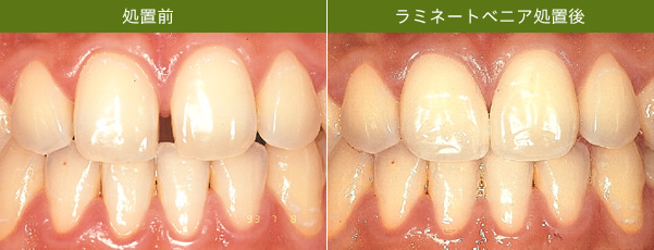 前歯２本の表面を0.3～0.5mm削って、セラミック（ポーセレン）の薄い板を貼り付けるだけで歯と歯のすき間をうめられます。
