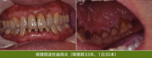 タバコと歯周病の関係 大阪大学歯学部 歯学部附属病院