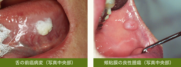 舌の前癌病変（写真中央部）　頬粘膜の良性腫瘍（写真中央部）