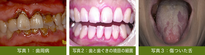 写真１：歯周病　写真２：歯と歯ぐきの境目の細菌　写真３：傷ついた舌
