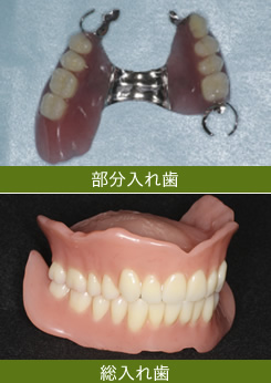 入れ歯の種類　部分入れ歯と総入れ歯
