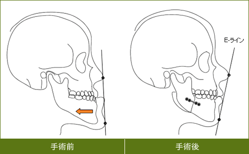 下あごの突端部と鼻先を結ぶ線「E-ライン」